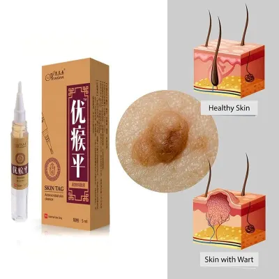 Remove The Skin of Moles and Genital Warts Quickly Remove The Inherent Anti-foot Corn Warts Papilloma Antibacterial Solution