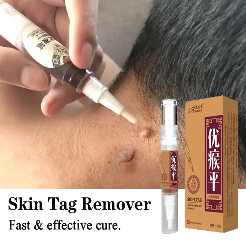 Skin Tag Remover Against Mole Genital Wart fast Remove Within al Anti Foot Corn Removal Warts Papillomas Rapidly removes moles